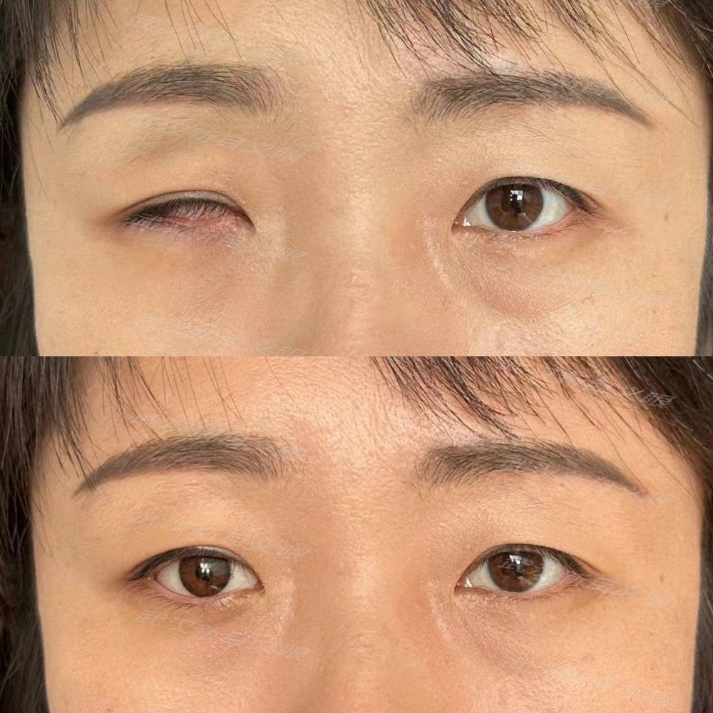 义眼佩戴效果对比