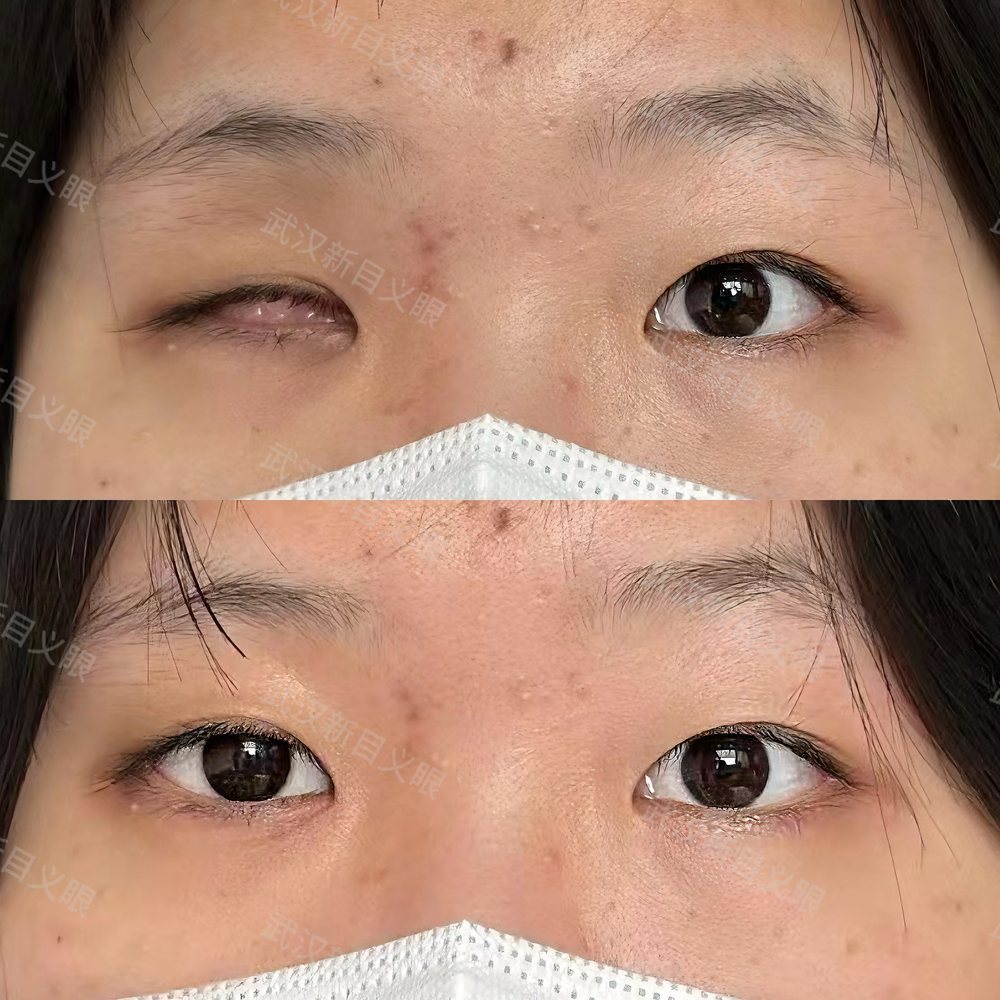 义眼佩戴效果对比